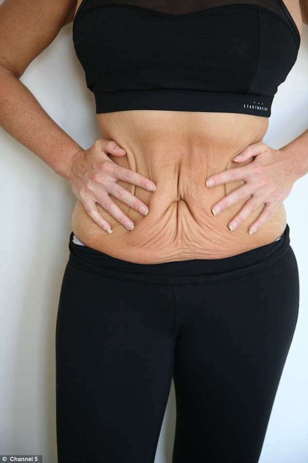 Loose Skin After Weight Loss Learn how to tighten it