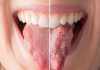 Home Remedies For Thrush- 15 best home remedies for Thrush Home remedies for Thrush