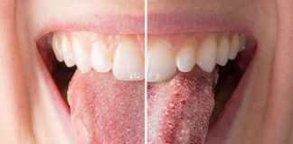 Home Remedies For Thrush- 15 best home remedies for Thrush Home remedies for Thrush