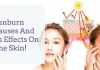 How to treat Sunburn?: Check out the leading causes of Sunburn and some home remedies to treat them! Home remedies for Sunburn