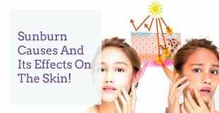 How to treat Sunburn?: Check out the leading causes of Sunburn and some home remedies to treat them! Home remedies for Sunburn