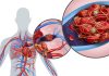 Signs of Blood Clot in Lungs: Recognizing the Actual Cause signs of blood clot in lungs