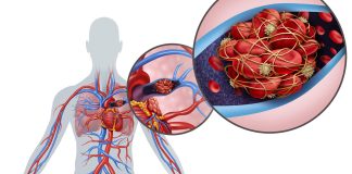 Signs of Blood Clot in Lungs: Recognizing the Actual Cause signs of blood clot in lungs