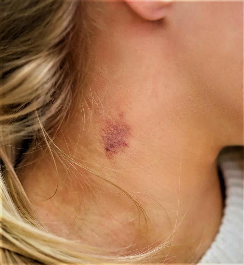 how to get rid of hickey overnight