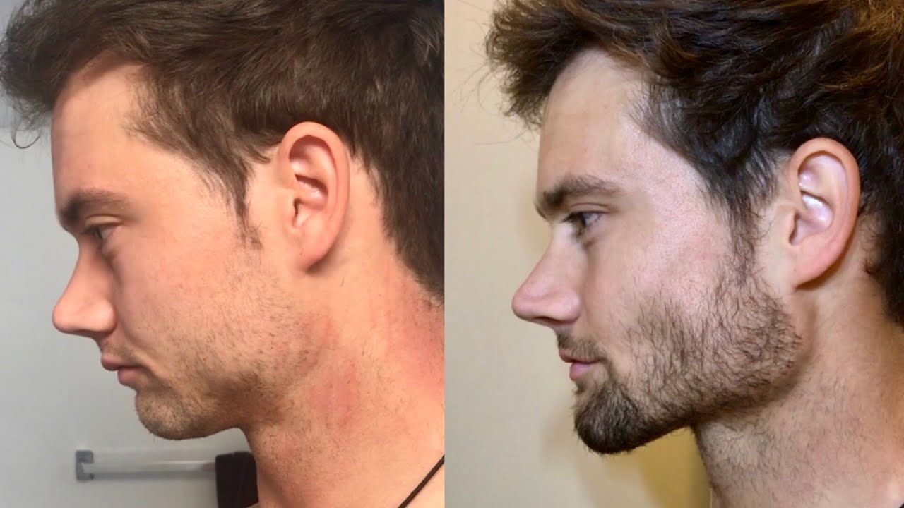 How To Get A Better Jawline Naturally
