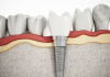 Your Gateway to Affordable Dental Implants and Quality Treatment in Budapest, Hungary