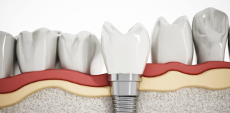 Your Gateway to Affordable Dental Implants and Quality Treatment in Budapest, Hungary